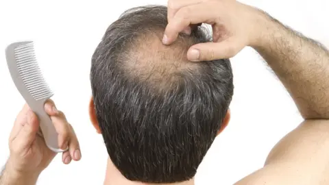 Getty Images Baldness