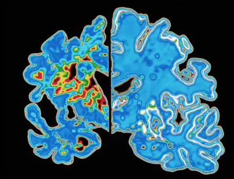 SPL Brain with dementia