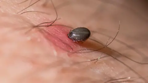 Getty Images A tick biting a human arm