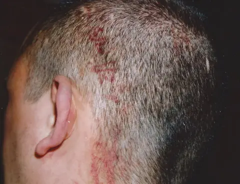 Colin Robertson The imprint of a boot was left on Colin's head after he had been stamped on by his attackers