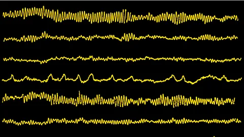 SPL Suppression of the brain's alpha waves may partly help explain the condition (Credit: SPL)