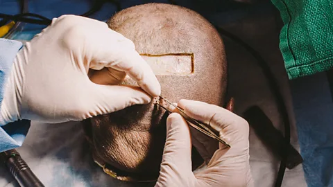 Cole Wilson Could the technique become the new 'gold standard' in hair replacement? (Credit: Cole Wilson)