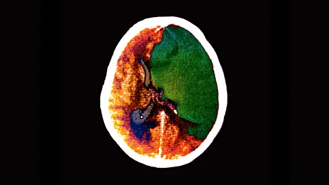 Science Photo Library A brain injury like a stroke will have a more pronounced effect on someone older, research suggests (Credit: Science Photo Library)