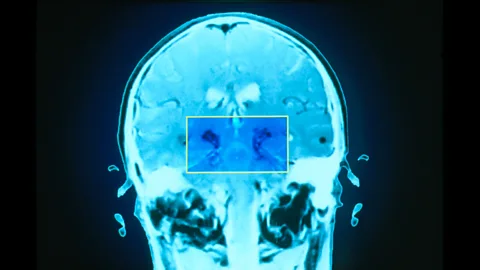 Science Photo Library Fatigue may arise from damage to the basal ganglia, highlighted here in the brain of someone with Parkinson's disease (Credit: Science Photo Library)
