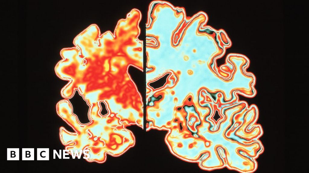Alzheimer’s researchers win brain prize