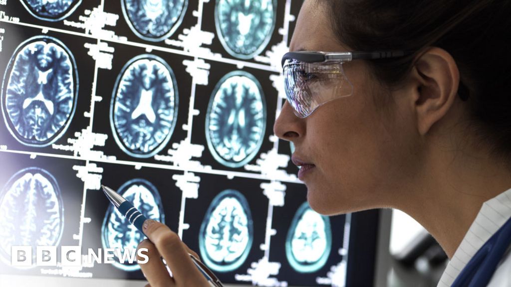 Scientists discover how brain cells die in Alzheimer’s Scientists discover how brain cells die in Alzheimer’s